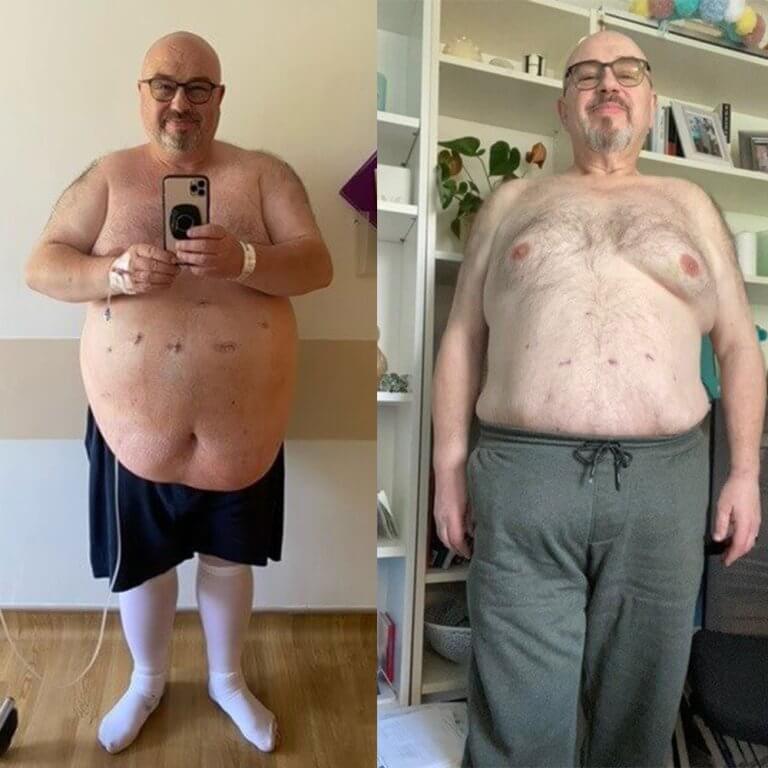 Dave-gastric-sleeve-before-and-after